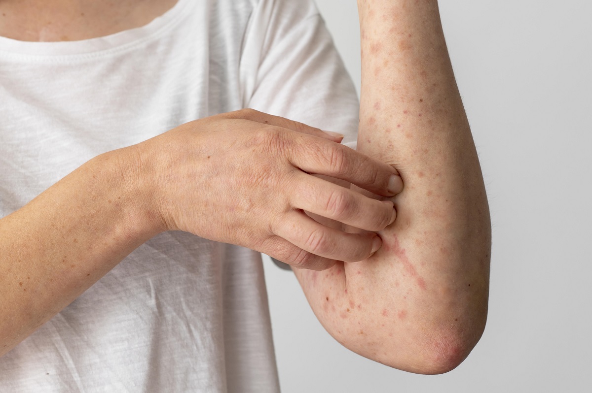 persona se rasca el brazo debido a que tiene la piel irritada porque tiene lupus