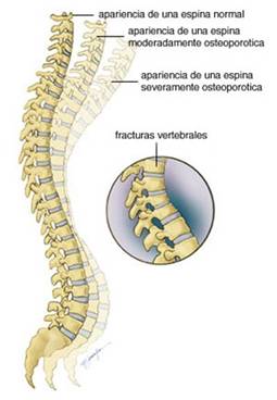 Apariencia de una espina dorsal normal, a la que se van superponiendo apariencias de espinas dorsales con osteoporosis moderada y severa. Fracturas vertebrales