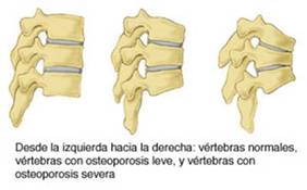 Desde la izquierda a la derecha: vértebras normales, vértebras con osteoporosis y vértebras con osteoporosis severa