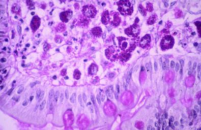 La imagen muestra el hallazgo típico de macrófagos PAS positivos infiltrando la lámina propia y la dilatación de los linfáticos