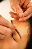 Mujer en sesión de acupuntura