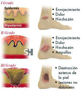 Los tres grados diagnósticos de profundidad de una quemadura, con las capas de la piel afectadas. Descrito en el texto