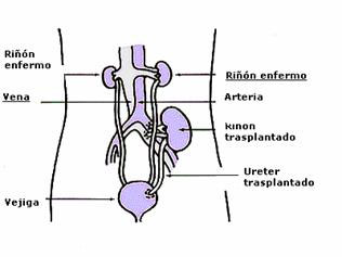 Dibujo que muestra la enfermedad renal, con dos riñones enfermos, el riñón trasplantado con las conexiones a una vena y una arteria. Del riñón trasplantado sale el ureter, también trasplantado, hasta la vejiga