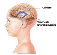 dibujo de niño con hidrocefalia y marcando su cerebro y ventrículo