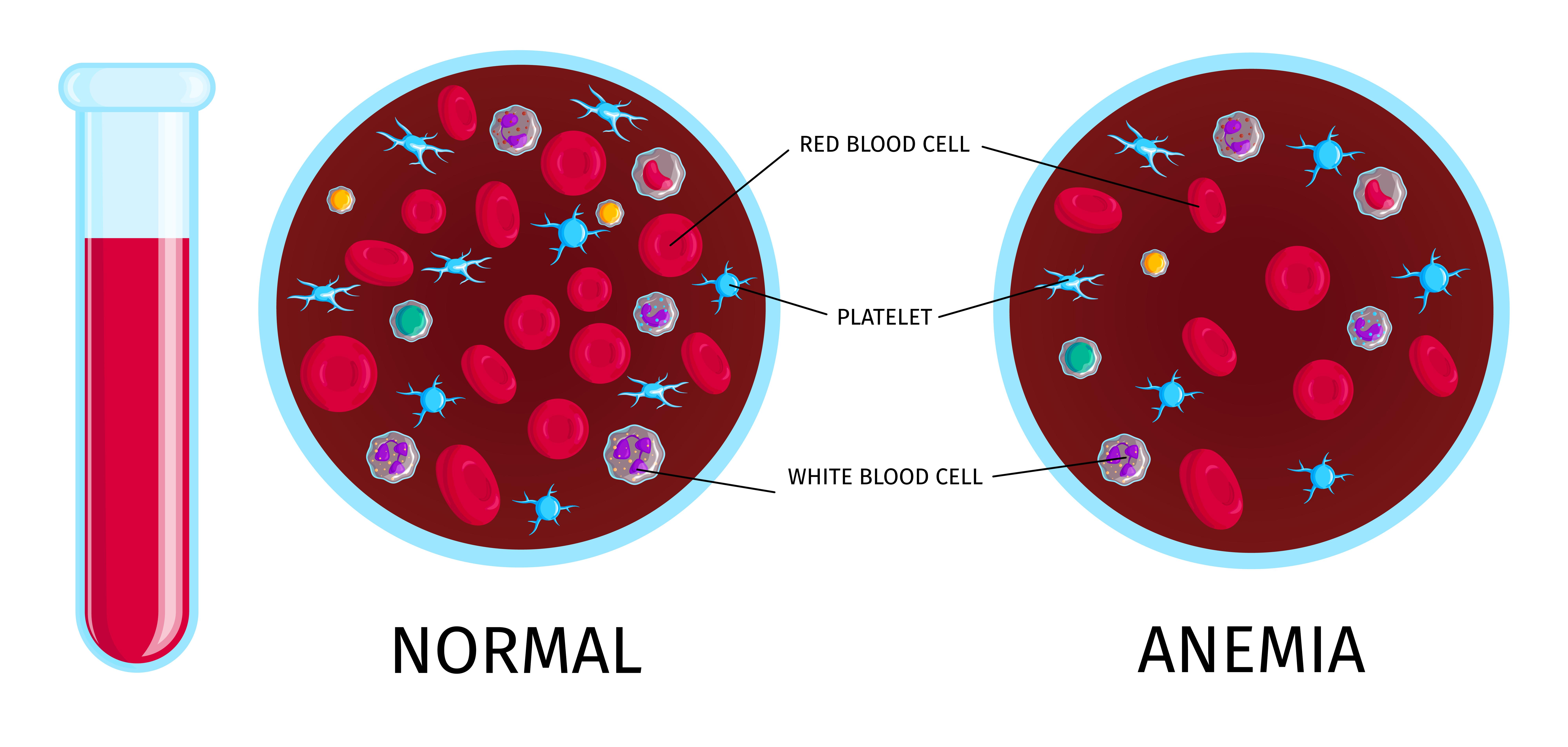 Se muestran dos imágenes comparando una persona con y sin anemia