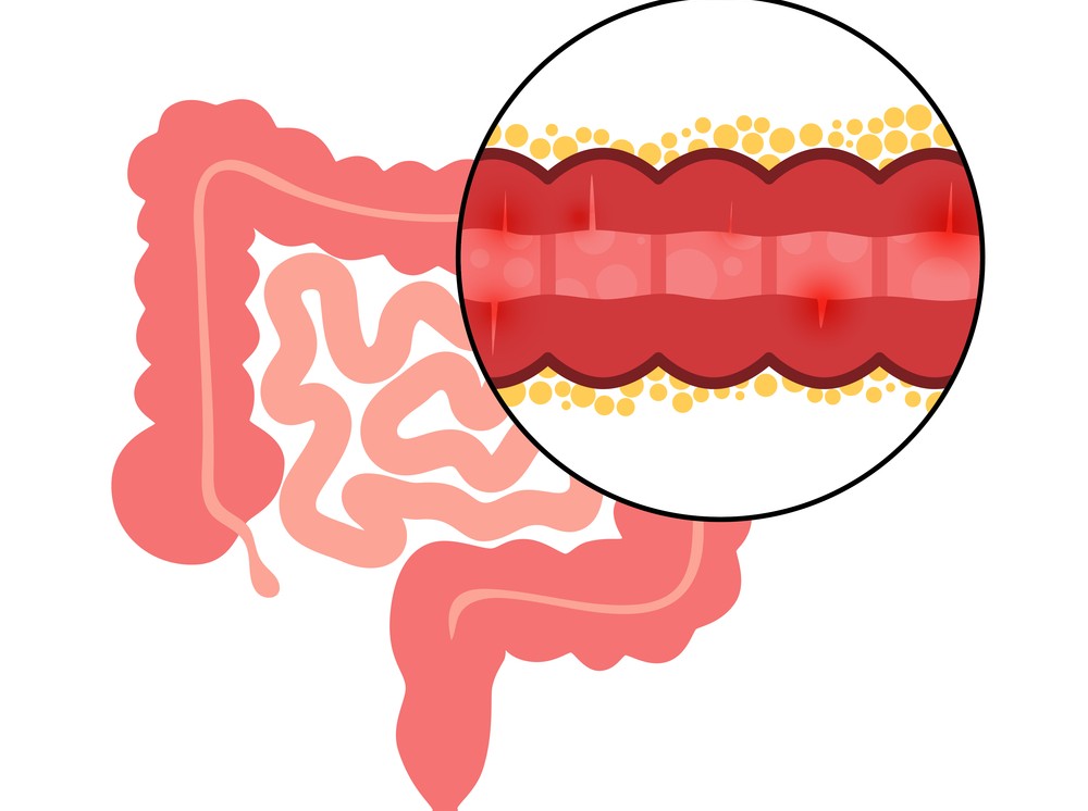Ilustración del aparato digestivo humano con un detalle ampliado de la pared intestinal. El recuadro muestra inflamación y engrosamiento de la mucosa intestinal, representando las lesiones asociadas a la enfermedad de Crohn. Predominan los tonos rosados y rojos sobre un fondo claro.