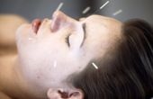 Una mujer sometiéndose a un tratamiento de acupuntura, con agujas en la cara