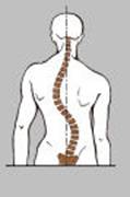 Imagen de columna desviada: escoliosis: Ataxia