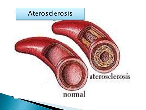 Comparación de una arteria normal con otra que tiene aterosclerosis