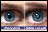 Comparación de un ojo con el cristalino normal y otro con el cristalino con catarata