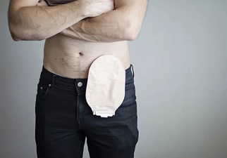 Una persona con colostomía