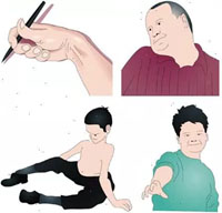 Dibujos de personas con distonia muscular