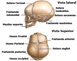 hidrocefalia
