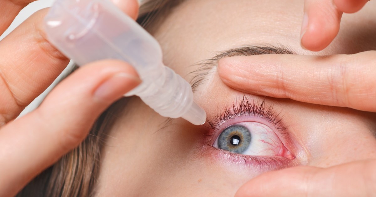 mujer echándose gotas en el ojo. Posible infección de los ojos.