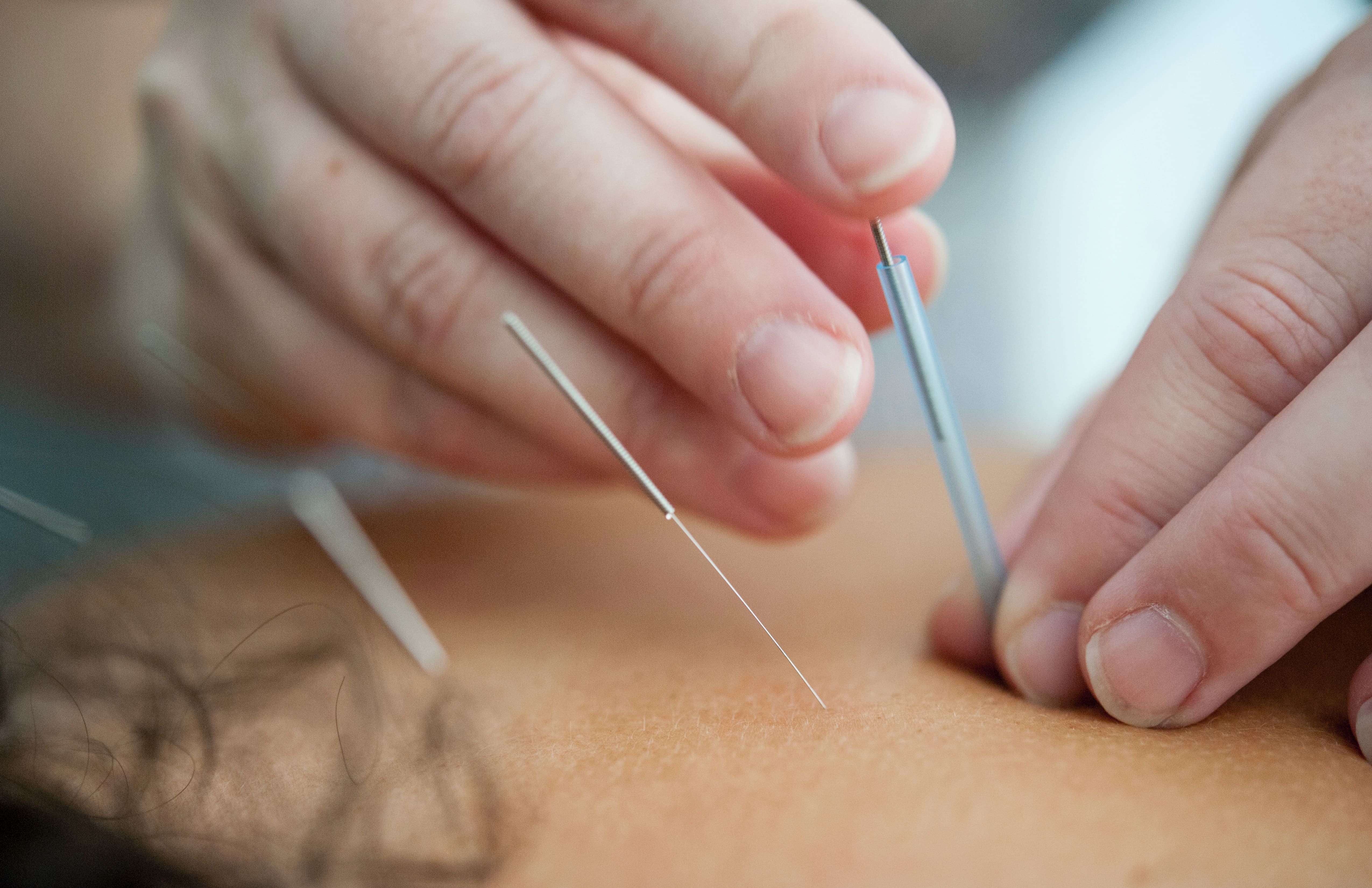 acupuntura