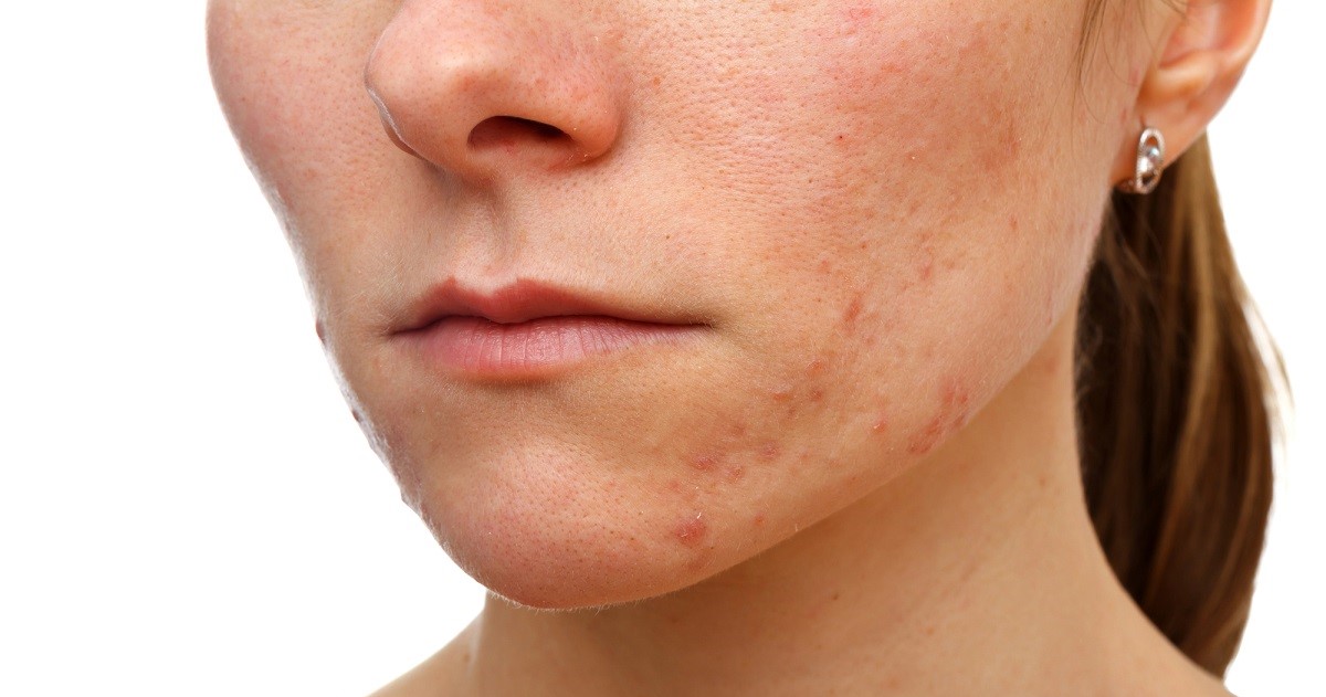 mujer con problemas de Infecciones de la piel y tejidos blandos