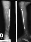 Radiografía de piernas afectadas por Osteogénesis Imperfecta