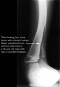 Radiografía de un hueso de la pierna de una persona con neurofibromatosis