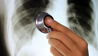 Una radiografía de unos pulmones con silicosis y un médico auscultandolos