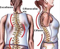 Síndrome de Marfan, imagen de una mujer con escoliosis