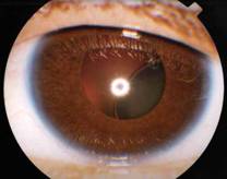 Imagen de un ojo de una persona con Síndrome de Marfan