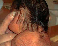 sindrome turner 3