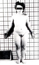 sindrome turner 2