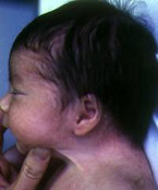 sindrome turner 4