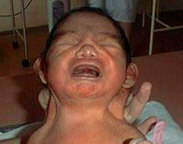 sindrome turner