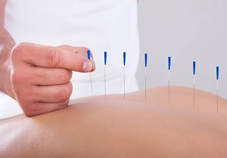 Acupuntura, uno de los tratamientos no farmacológicos más aconsejado para las cefaleas