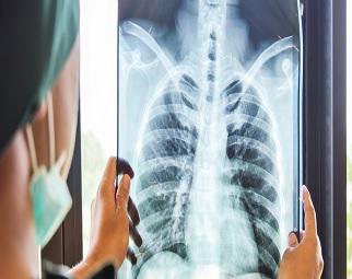 Un doctor con una radiografía de un enfermo de Tuberculosis