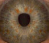Imagen del iris del ojo con nódulos de Lisch Neurofibromatosis