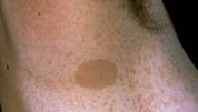Imagen de una mancha café con leche en una piel de una persona con Neurofibromatosis