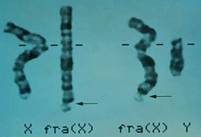 Imagen de los cromosomas sexuales xx y xy, síndrome de x frágil
