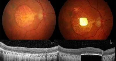 aparece el ojo por dentro y un chip implantado en él.