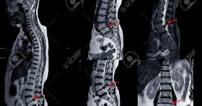 RNM de la columna lumbar que muestra una grave mielopatía medular 