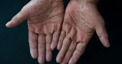 Imagen de dos manos con descamaciones, fruto de una enfermedad rara