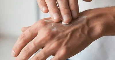 Una persona utilizando una crema especial para el cuidado de la piel durante un proceso de tratamiento oncológico (Fuente: Kernpharma Pacientes)