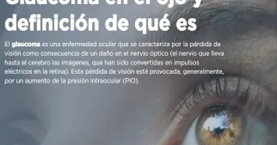 Banner por el Día Mundial del Glaucoma, con la definición de esta enfermedad y los ojos de una persona (Fuente: Clínica Baviera)
