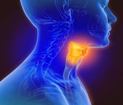Ilustración 3D de cáncer de garganta