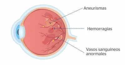 proceso explicativo de la retinopatía diabética