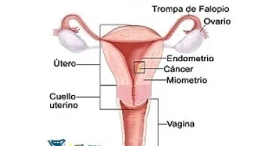 Representación gráfica de como se forma el cáncer de endometrio en una mujer