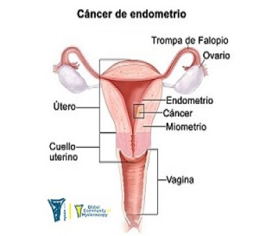 Representación gráfica de como se forma el cáncer de endometrio en una mujer
