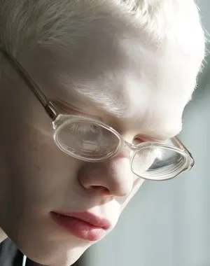 Joven estudiante con albinismo y gafas para corrección de la vista