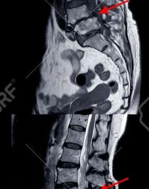 RNM de la columna lumbar que muestra una grave mielopatía medular 