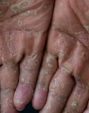 Imagen de dos manos con descamaciones, fruto de una enfermedad rara