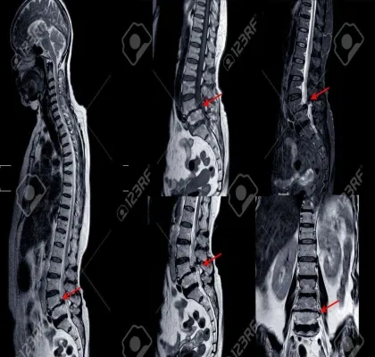 RNM de la columna lumbar que muestra una grave mielopatía medular 