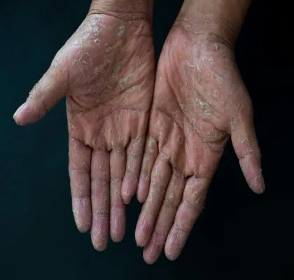 Imagen de dos manos con descamaciones, fruto de una enfermedad rara