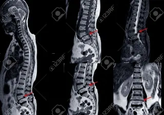 RNM de la columna lumbar que muestra una grave mielopatía medular 