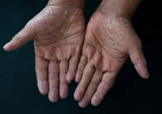 Imagen de dos manos con descamaciones, fruto de una enfermedad rara